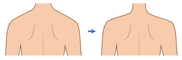肩ボトックス