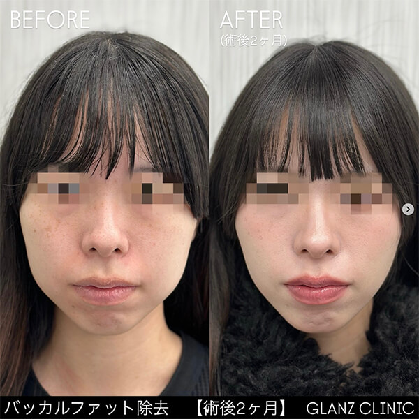 バッカルファット除去 症例写真-01