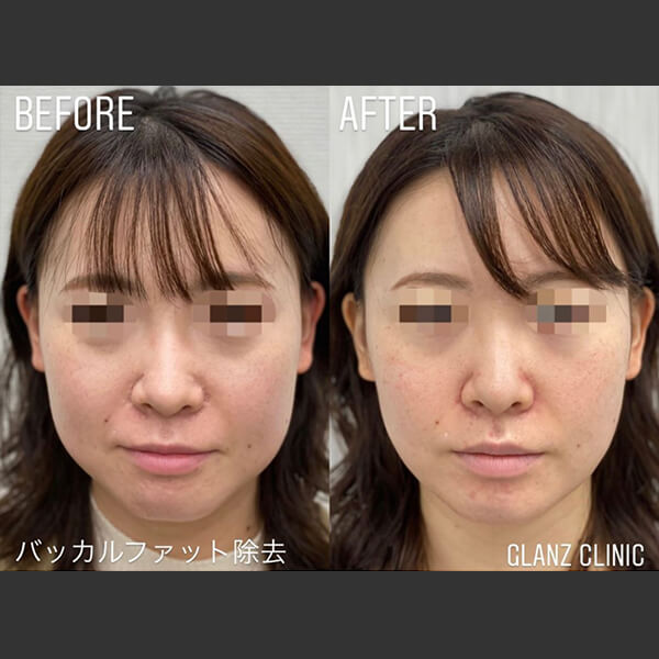 バッカルファット除去 症例写真-02