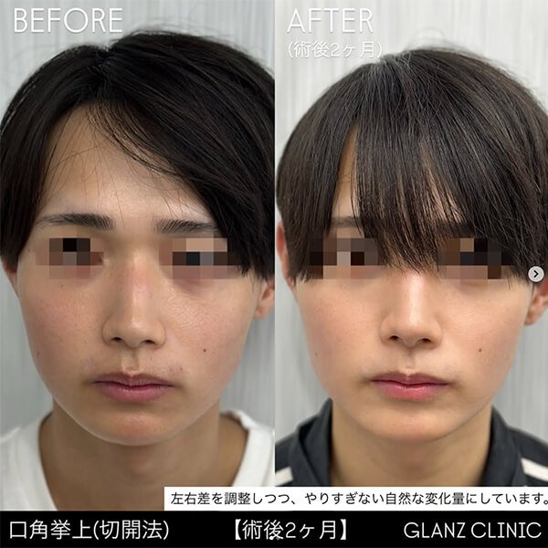 口角挙上 症例写真-01