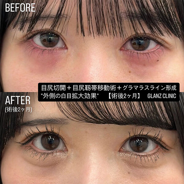 グラマラスライン形成 症例写真-02