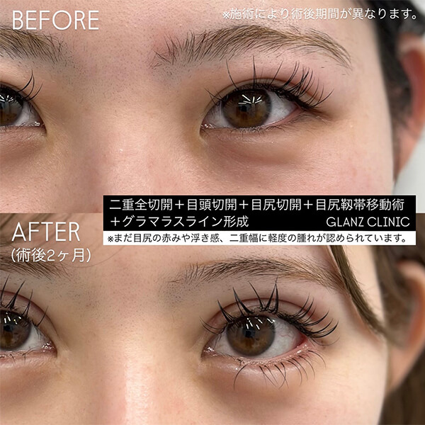 グラマラスライン形成 症例写真-03