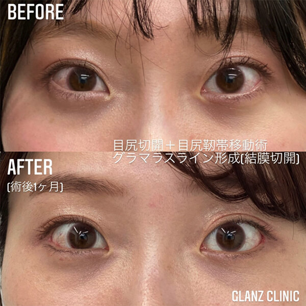 グラマラスライン形成 症例写真-04