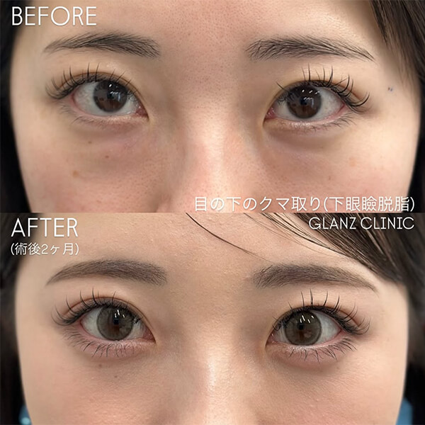 目の下のクマ取り 症例写真-01