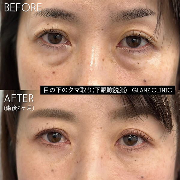 目の下のクマ取り 症例写真-02