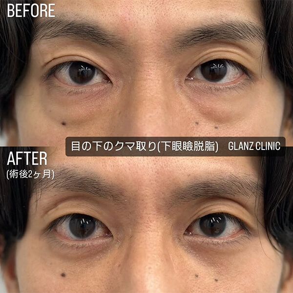 目の下のクマ取り 症例写真-03