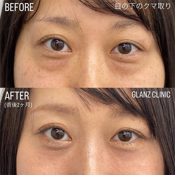 目の下のクマ取り 症例写真-04