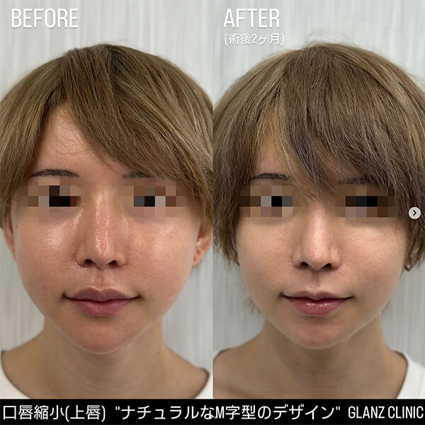 口唇縮小 症例写真-01