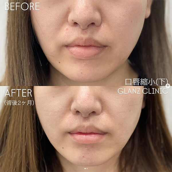 口唇縮小 症例写真-02