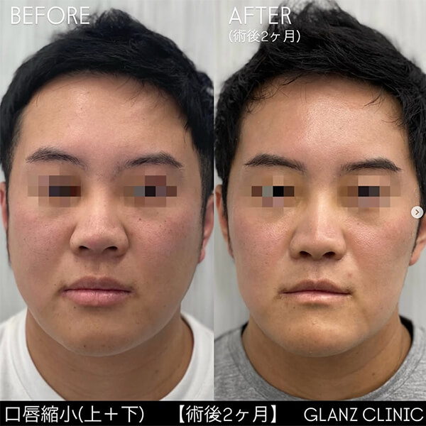 口唇縮小 症例写真-03