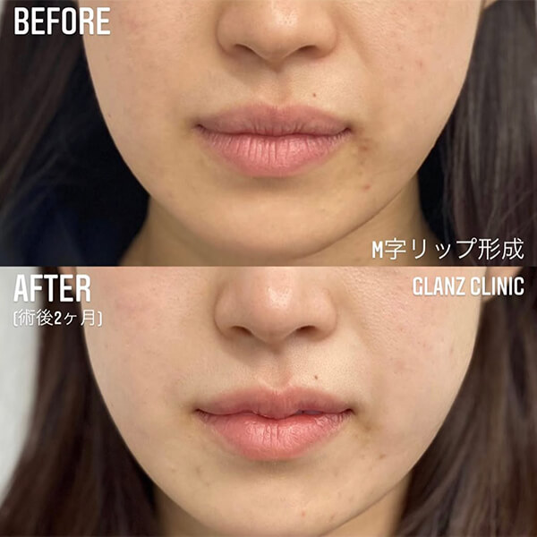 M字リップ 症例写真-03