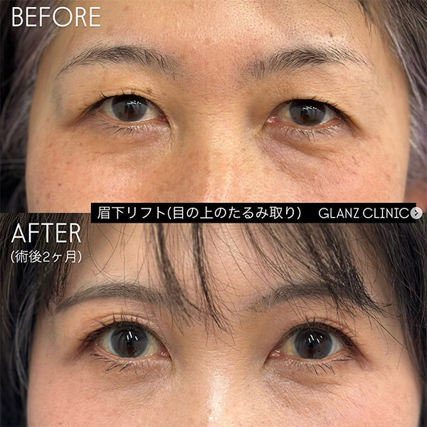 眉下リフト 症例写真-01
