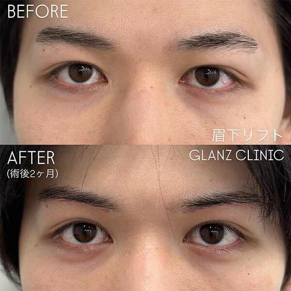 眉下リフト 症例写真-02