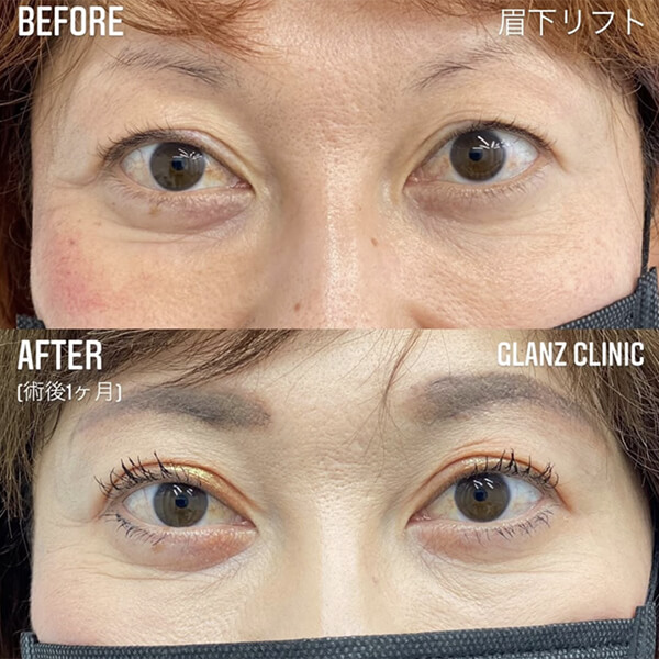 眉下リフト 症例写真-03