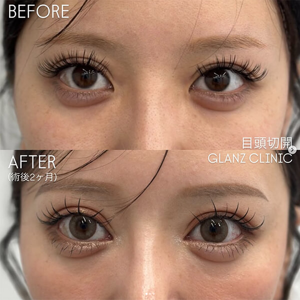 目頭切開 症例写真-01