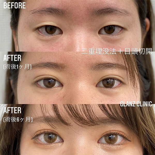 目頭切開 症例写真-02