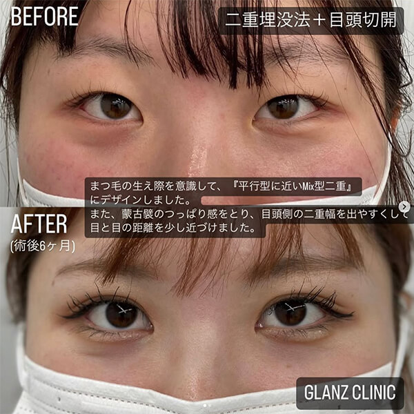 目頭切開 症例写真-03