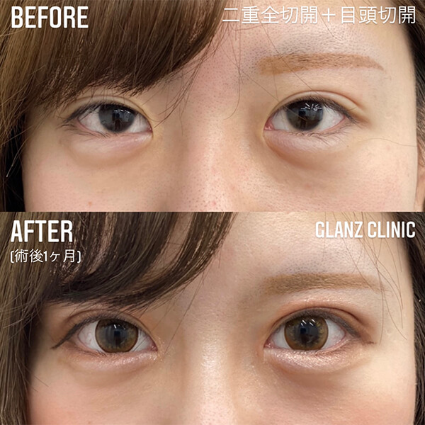 目頭切開 症例写真-04