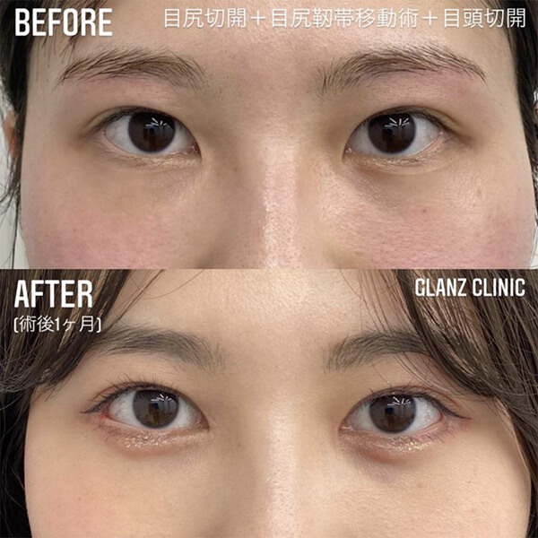 目頭切開 症例写真-05