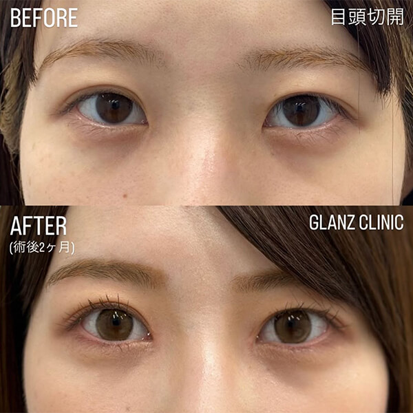 目頭切開 症例写真-06