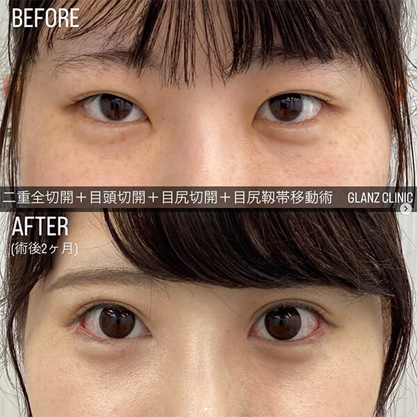 目頭切開 症例写真-07