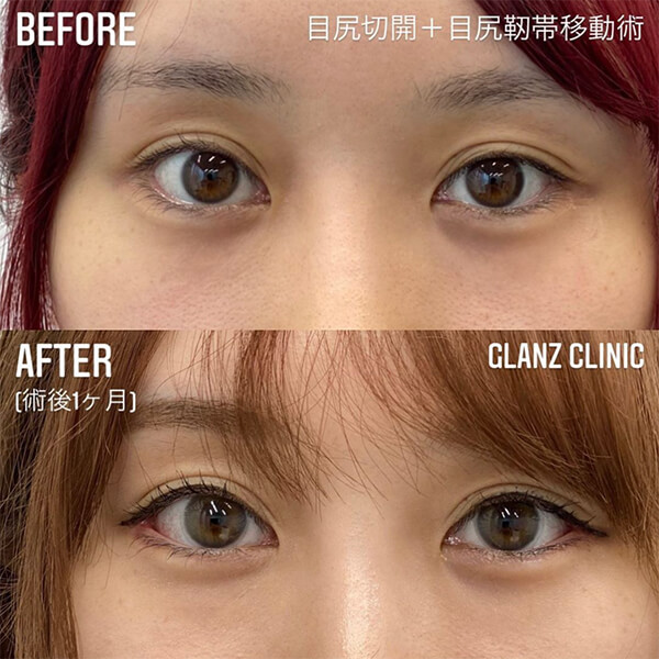 目尻切開 症例写真-01