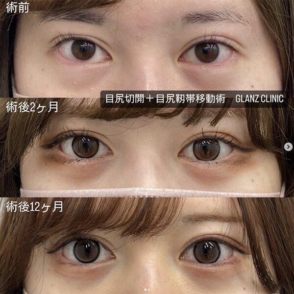 目尻切開 症例写真-02