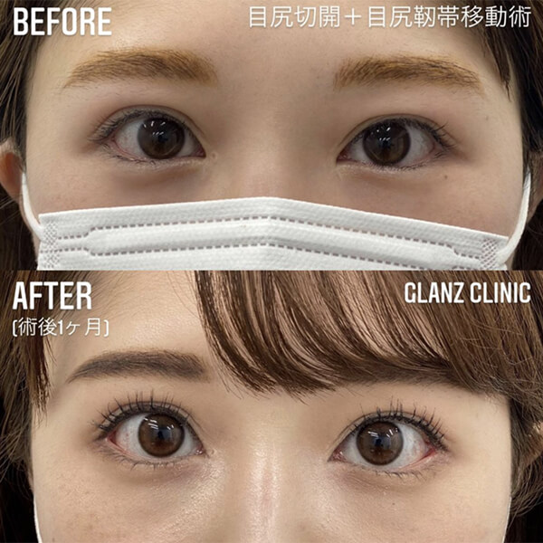 目尻切開 症例写真-03