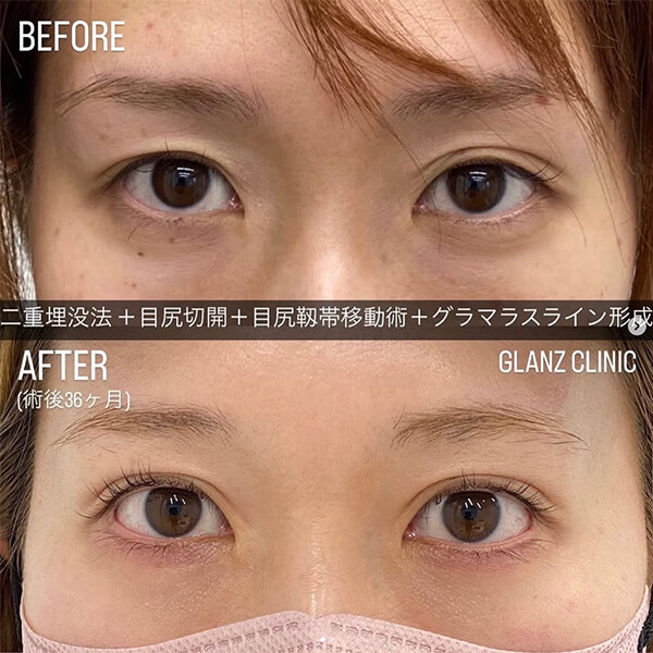 目尻切開 症例写真-05