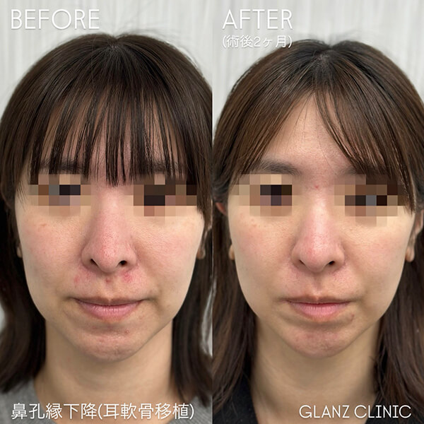 鼻孔縁下降 症例写真-01
