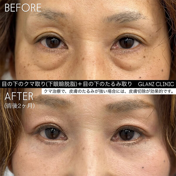 目の下のたるみ取り 症例写真-01
