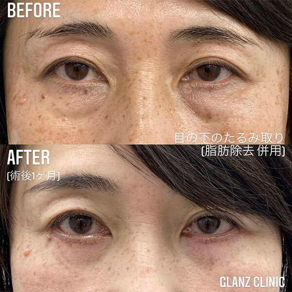 目の下のたるみ取り 症例写真-02