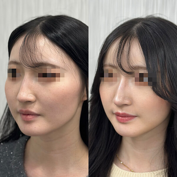 症例写真-04