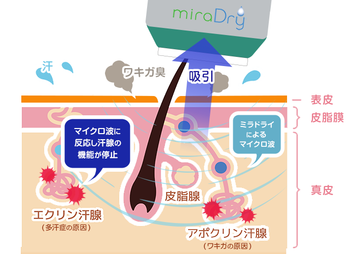 ミラドライのわきが治療メカニズム