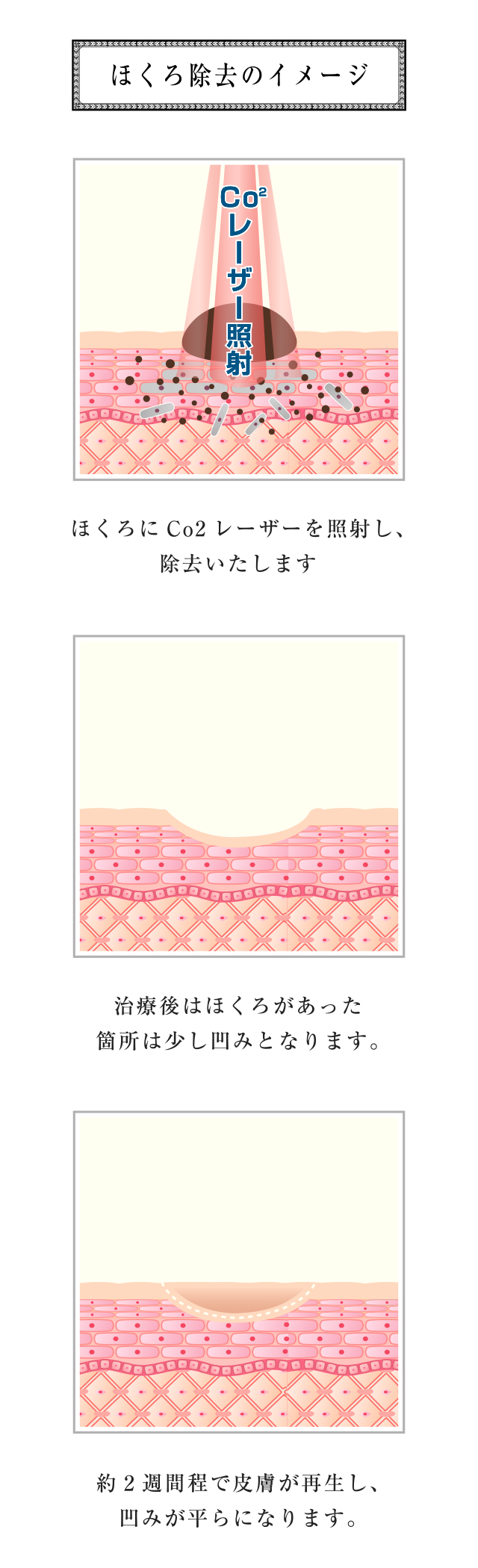 当院で取り扱っているほくろ・イボ